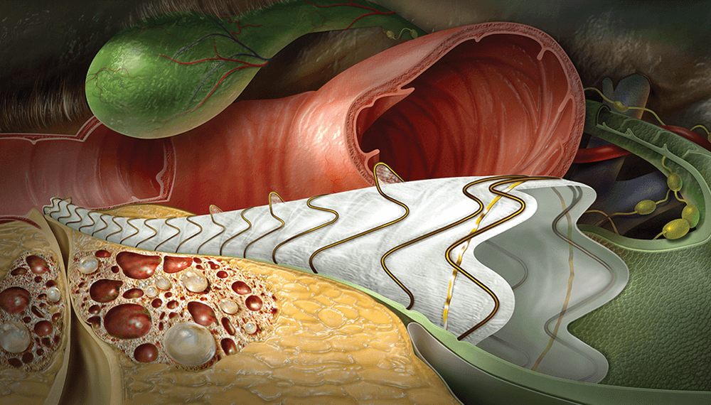 animation of gore viabil in the abdominal cavity surrounding other organs