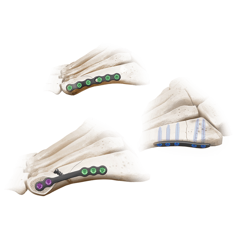 5MS® Plating System