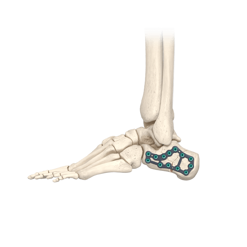 CoLink<sup>®</sup> Cfx Calcaneal Fixation System