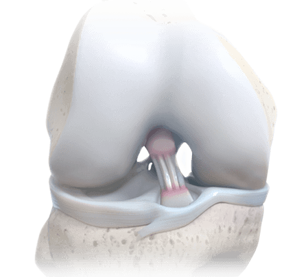 BioBrace on the knee