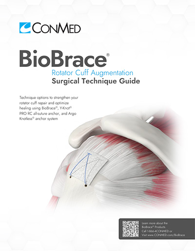 BioBrace Surgical Technique Guide