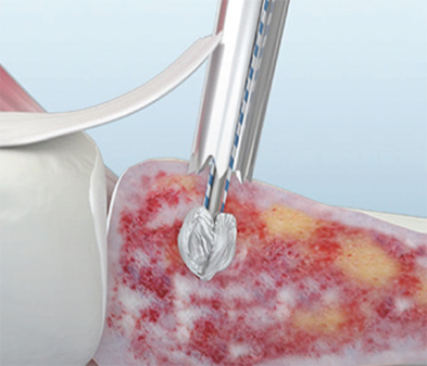 Ilustración TruShot de la fijación fuerte del anclaje con nudo en Y