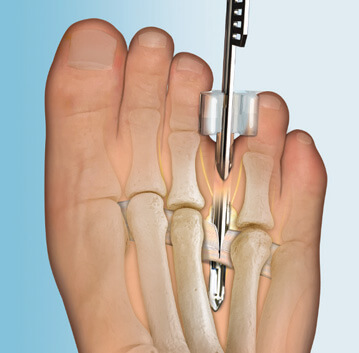 ClearGuard LE Nerve Decompression