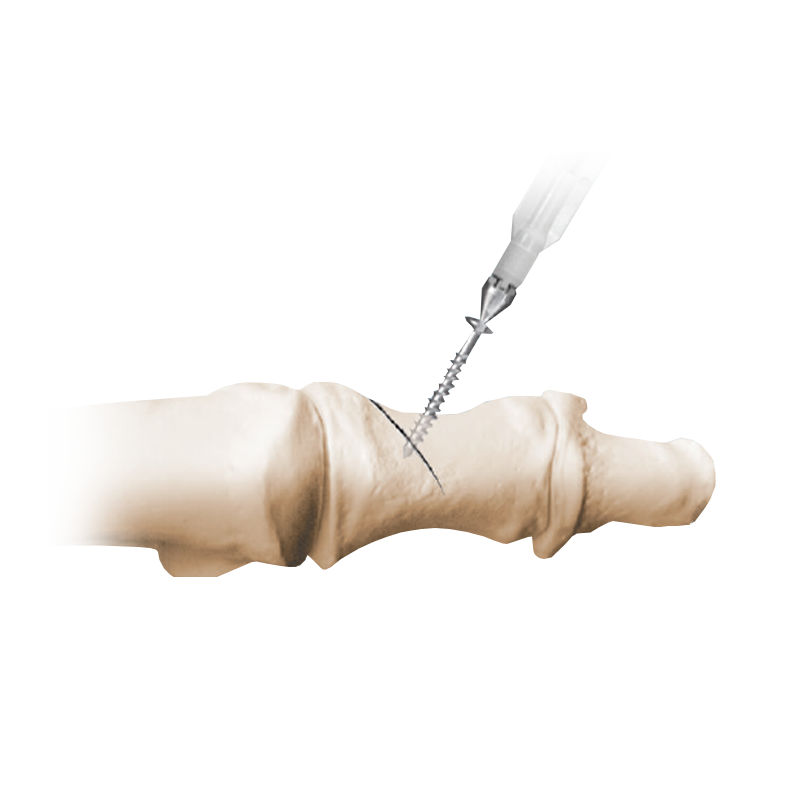 NeoSys® Single-Use Instrumentation