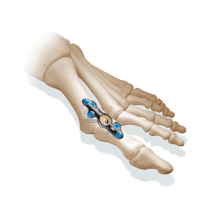 CoLink® View MTP and Lapidus Dynamic Compression Plating System
