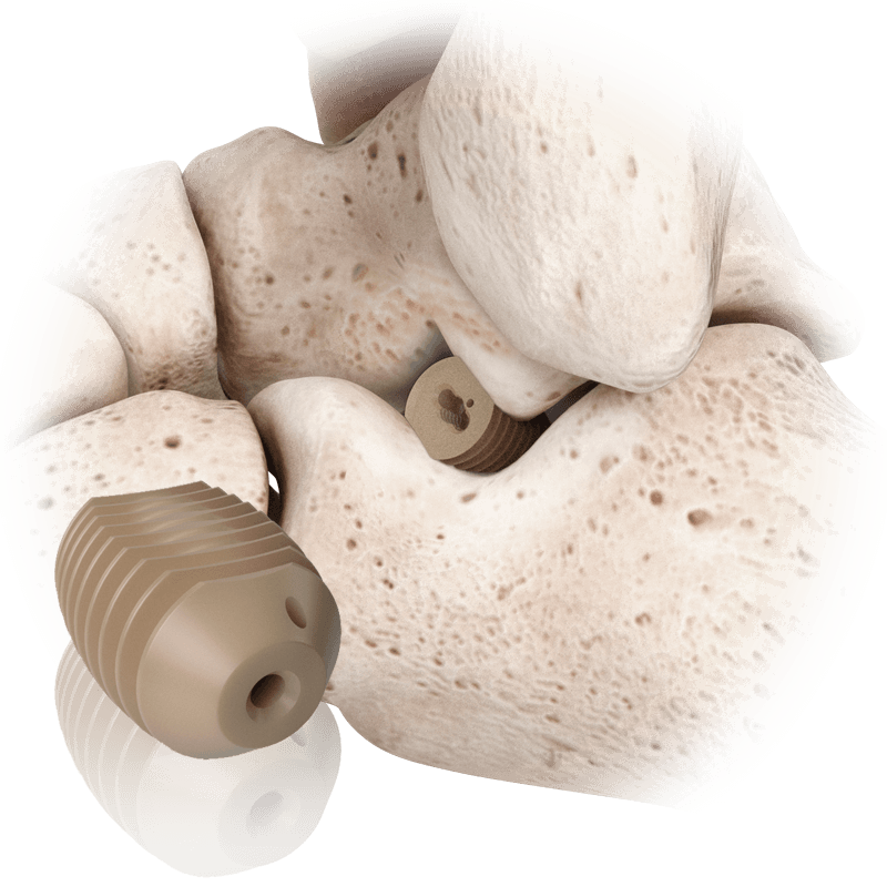 PitStop™ Subtalar Implant