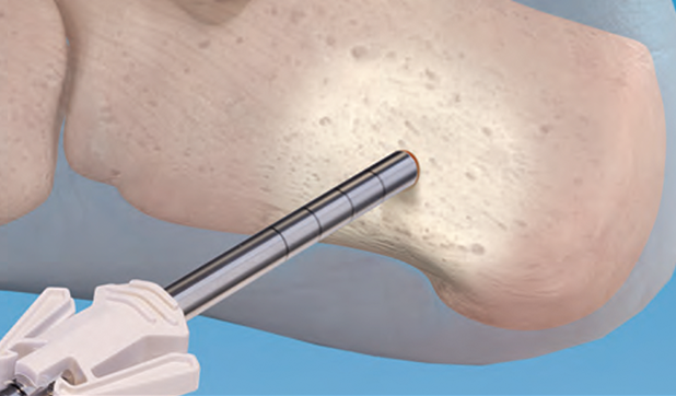 Autograft Harvest Technique Using CoLink Bone Graft Harvester and Tribio™ Backfill Plugs