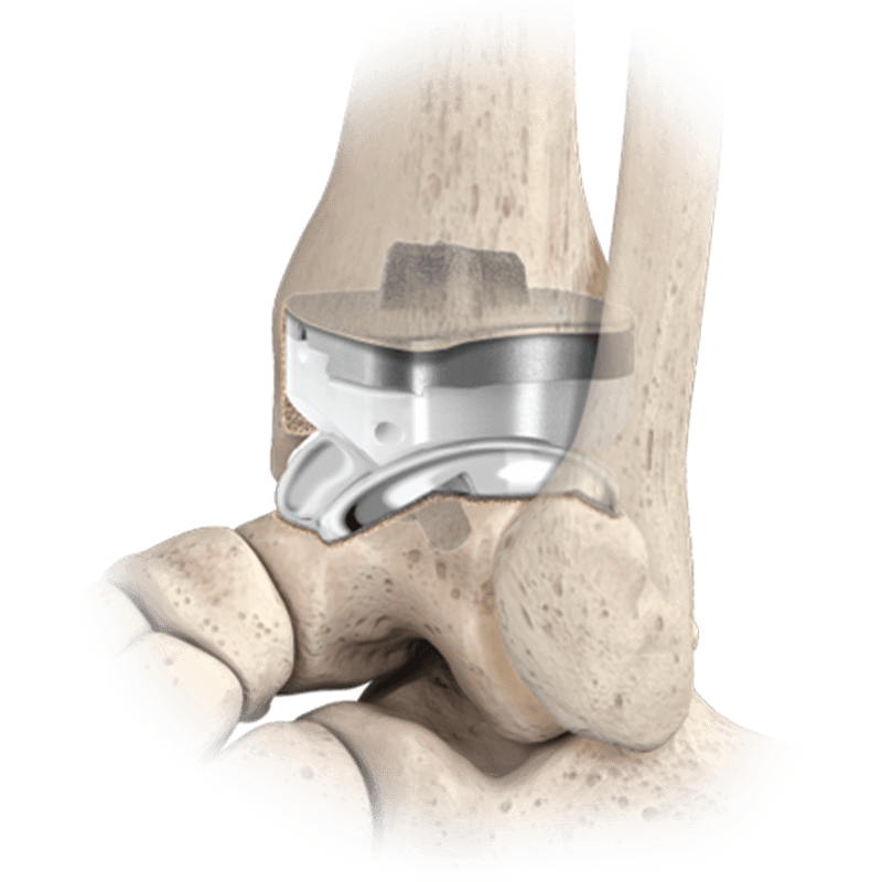 Quantum® Total Ankle System